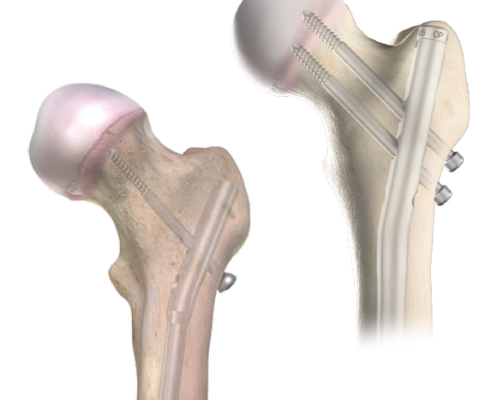 Rigid Nail implant in the bone