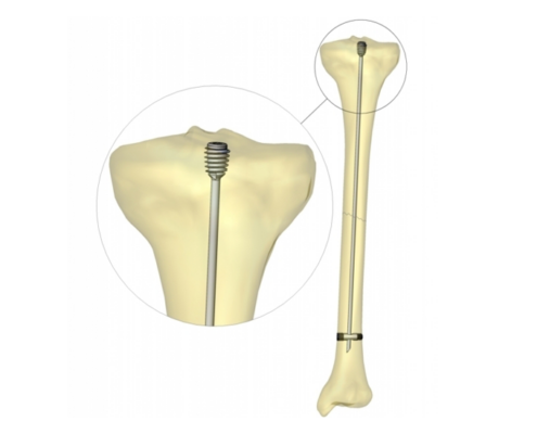 diagram showing the SLIM system in a bone. The top part of the implant in the bone is enlarged for viewing purposes.