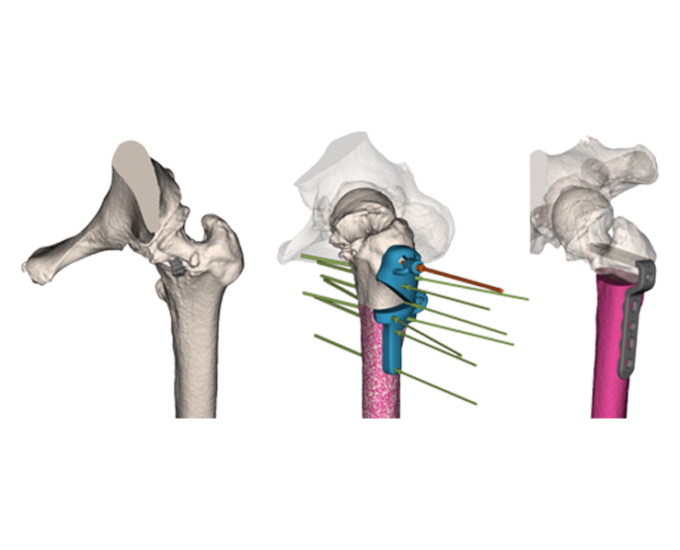 Image of a 3D Side model in the bone.