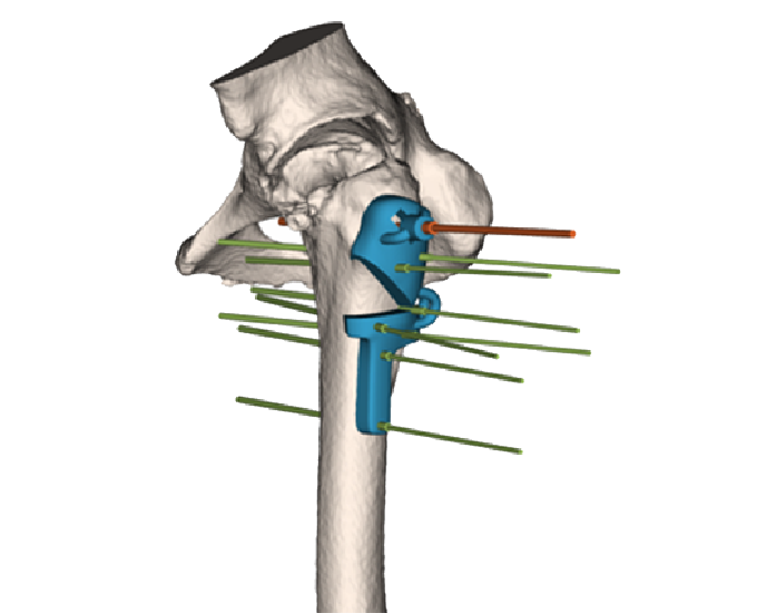 Image of a 3D Side model in the bone.